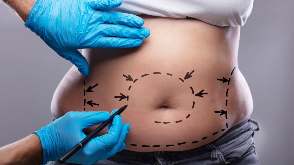 Can Obese People Get Liposuction? Other Ways for weight loss