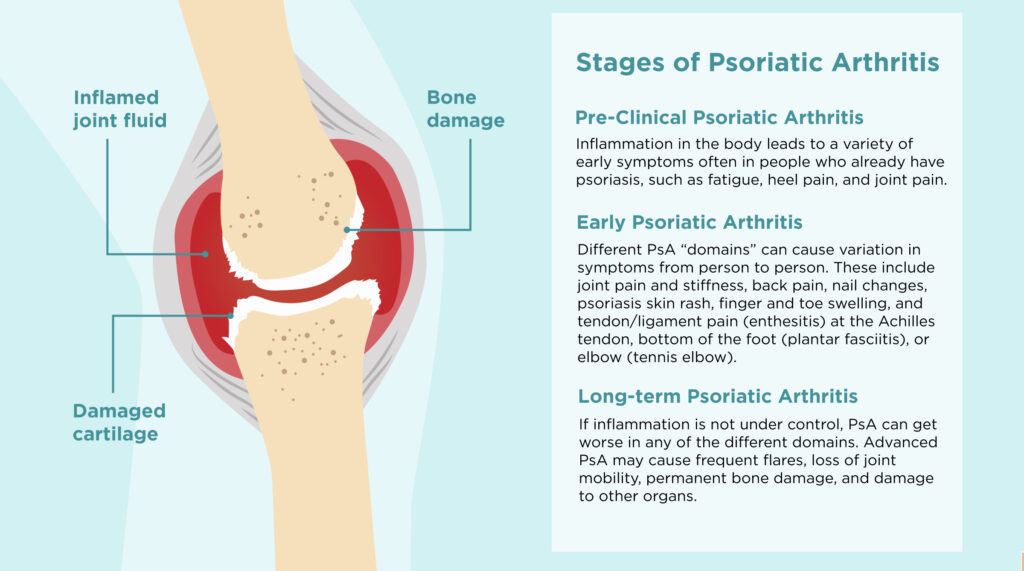 Stages of psoriatic arthritis