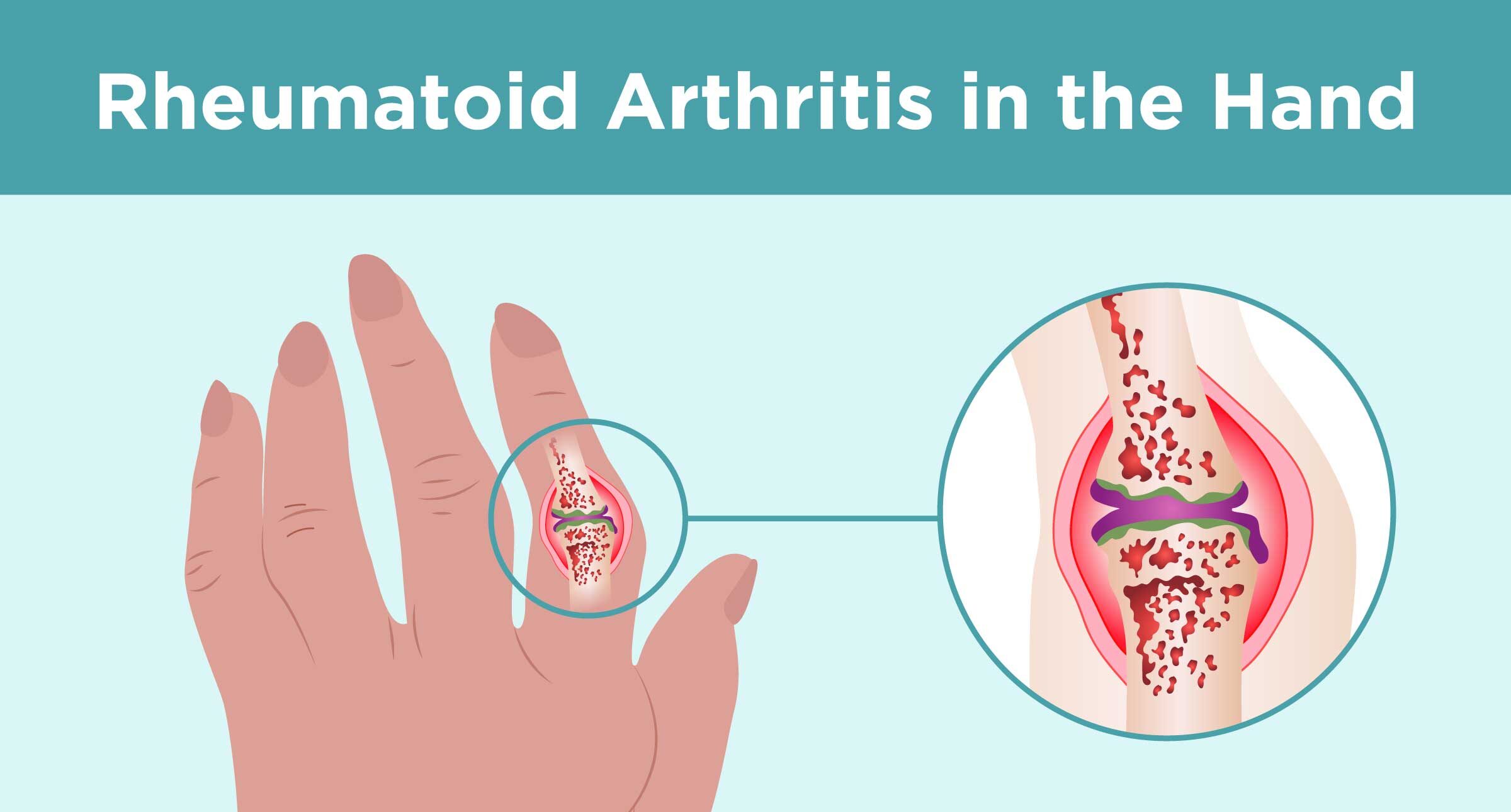 What Causes Arthritis In Fingers WireCandy