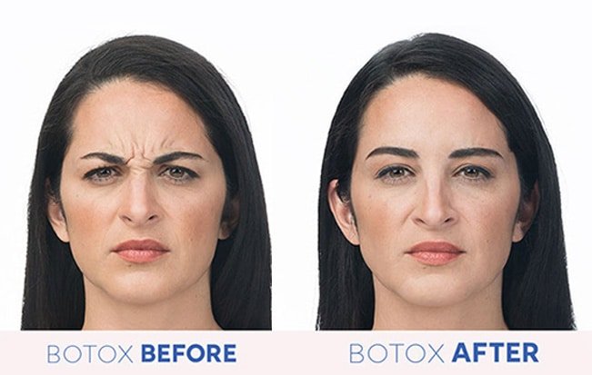 The Science Behind Botox – How It Works on Wrinkles