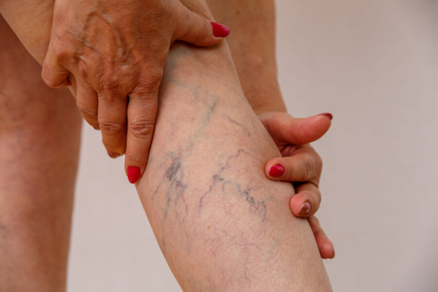 Varicose veins