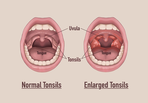 can tonsils grow back after being removed?